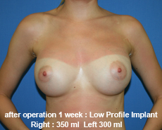 plastic-surgery-breast-augmentation